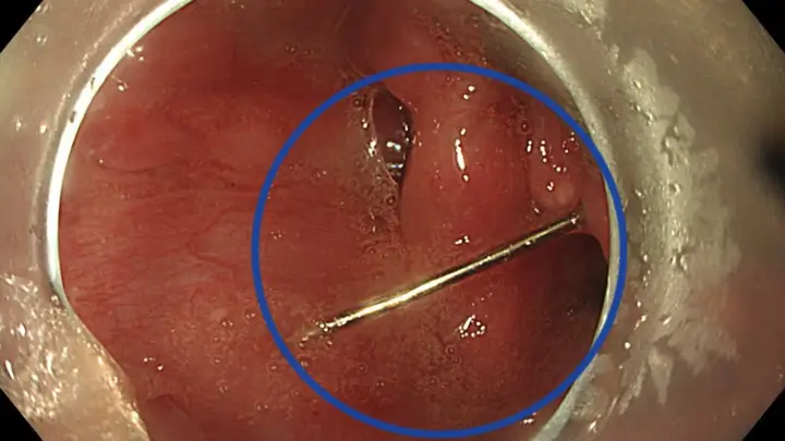 В Подмосковье хирурги спасли девочку с иглой в горле