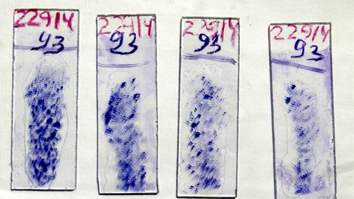 Тяжёлое комбо. Врач рассказал, для кого опасна вспышка микоплазмы в мире