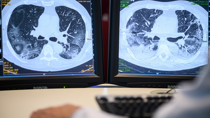 Вскрытие показало: Учёные нашли ответ на важный вопрос о COVID-19