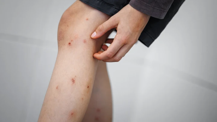 В Европе распространяется супергрибок: дерматолог объяснил, в чем его опасность