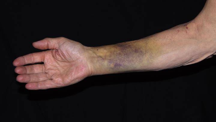 Хирург Акулова назвала причины частого появления синяков