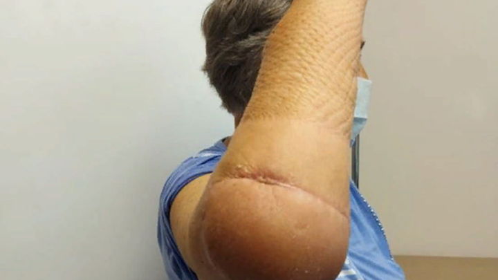 На Кубани врачи помогли женщине с дефектом локтя