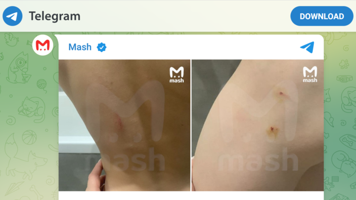 Mash: в Подмосковье воспитательница детского сада до крови истыкала мальчика карандашом