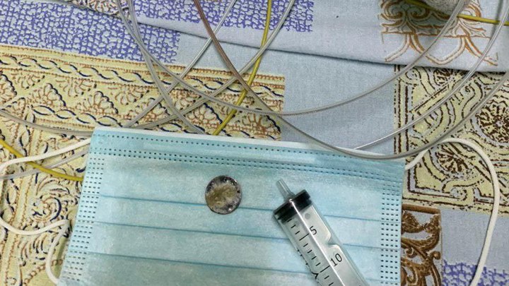 В Туапсе врачи спасли двух детей, которые проглотили батарейки