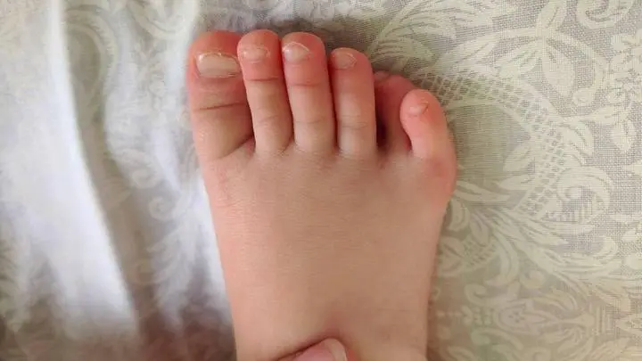 В Подмосковье травматологи удалили по одному лишнему пальцу со стоп ребенка