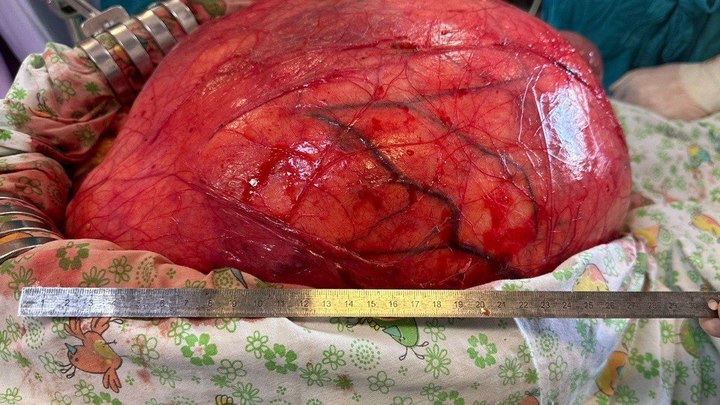 Кубанские медики удалили у мужчины огромную опухоль весом 17 кг