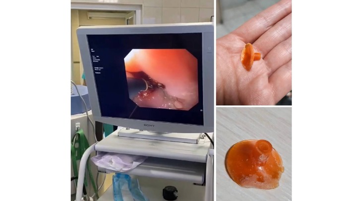 3-летний малыш жил с присоской от дротика в пищеводе