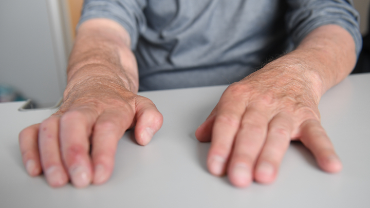 Кому стоит опасаться инсульта: Названы три говорящих состояния пальцев