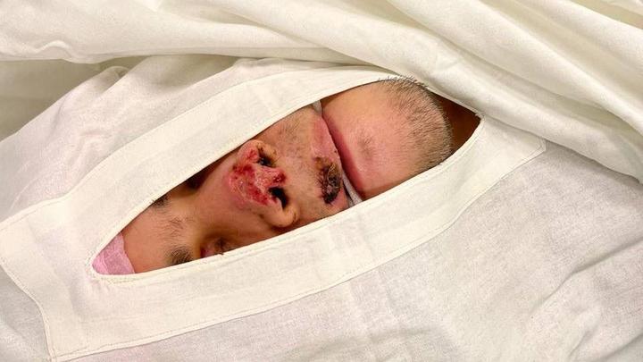 Краснодарские врачи пришили мужчине откушенный на вечеринке нос