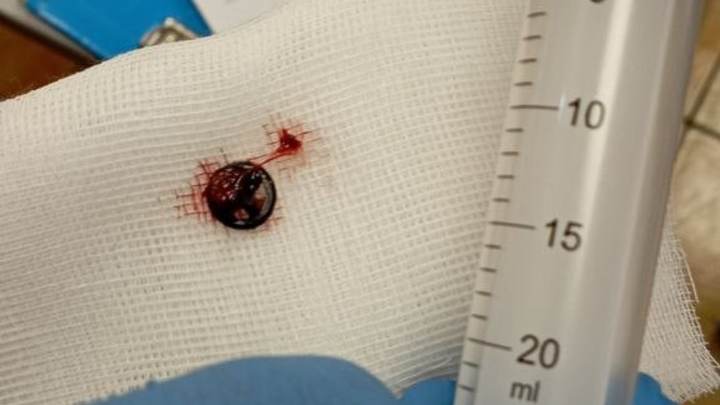 Пятилетний мальчик в Ступино месяц проходил с рулем от машинки в носу