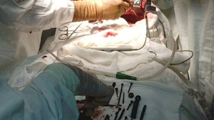 Врачи совершили чудо – хирургам удалось достать осколок мины из бьющегося сердца бойца
