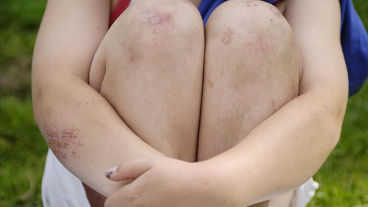 В Смоленске подростки избили мальчика-инвалида: Самое тяжёлое - не синяки