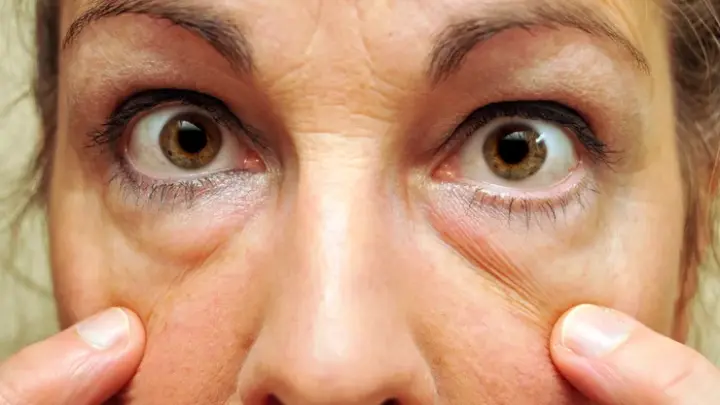 Онколог Ивашков: Припухлость век по утрам - признак избытка соли в рационе