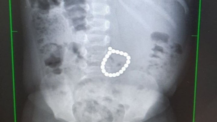 Ребёнку повезло дважды: Врачи достали из живота двухлетки браслет из 20 магнитов
