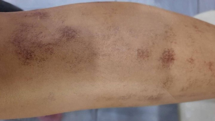 Процедура лазерной эпиляции закончилась для жительницы Краснодара 40% ожогов кожи