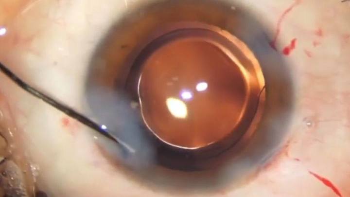 Новороссийские врачи вернули зрение 93-летней пациентке дома-интерната