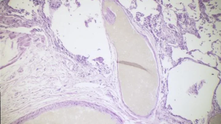 Больше не больно: Умерла Таисия Шеремет - автор блога о муковисцидозе. Что известно о смерти