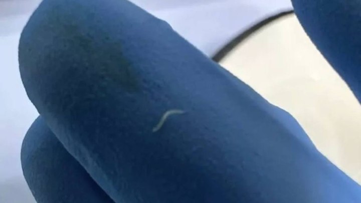 Спасли жизнь: новороссийские врачи достали из тела пациента клубок паразитов