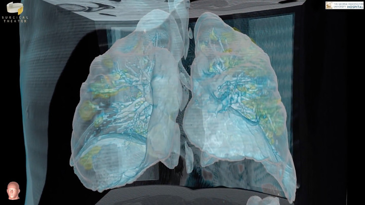 В лёгких у бессимптомных пациентов COVID-19 обнаружили эффект матового стекла