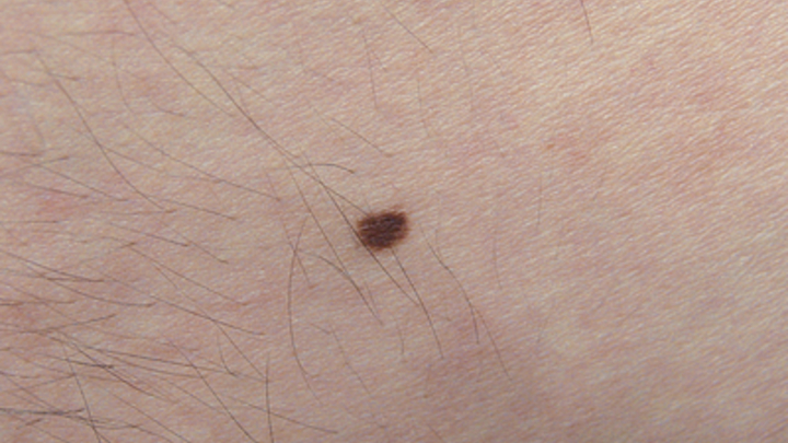 Чёрная королева онкологии: Пять признаков смертельной болезни