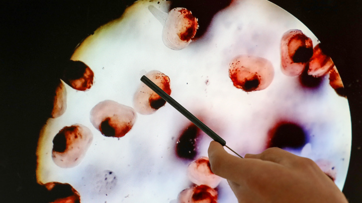 Поймать рак на ранней стадии: Онколог назвал оптимальные сроки проверок