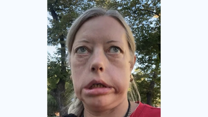 Вместо лица маска: Эту болезнь в России не лечит никто