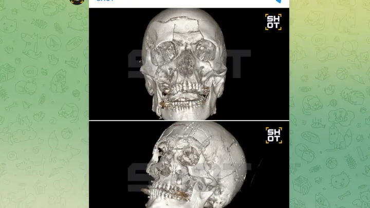 В Жуковском мужчина раскрошил всё лицо из-за падения со снегохода