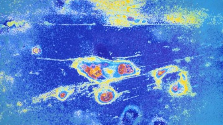 Как рак захватывает тело: Врачи раскрыли механизм