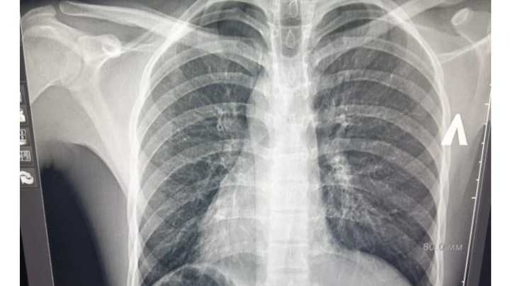 Краснодарские врачи спасли иностранца с зеркальными органами