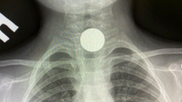 В Туапсе врачи достали монету из пищевода 4-летнего мальчика