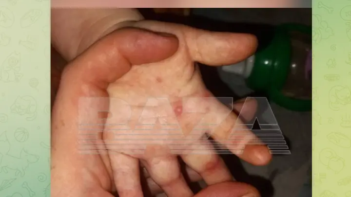 Родители бьют тревогу из-за вспышки Коксаки в детсадах в регионах страны
