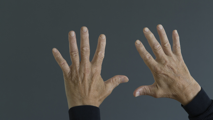 На кончиках пальцев. Назван быстрый способ определить рак по внешнему виду рук