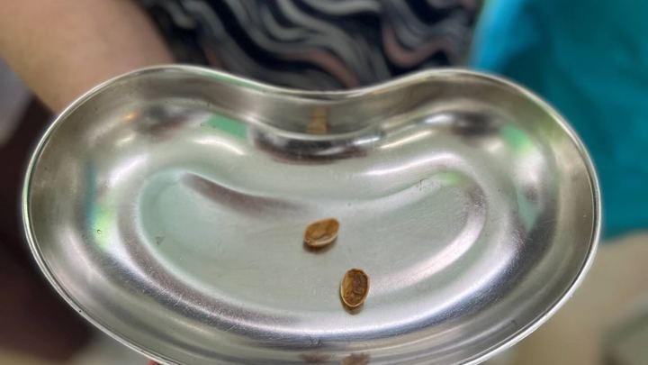 Пожилая жительница Лобни могла задохнуться из-за фисташек