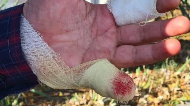 В Анапе охраннику закладчики наркотиков отрезали часть мизинца