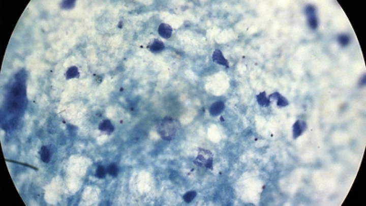 Исследование выявило, как вес меняет последствия ковида