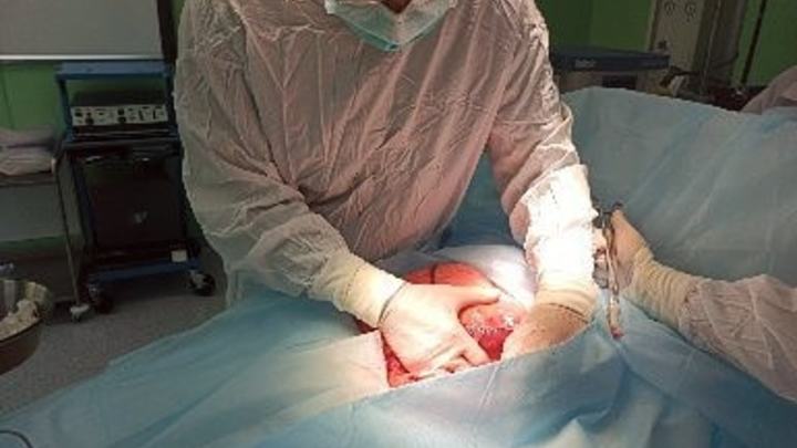 В Краснодаре хирурги вырезали у пациента опухоль весом 10 кг