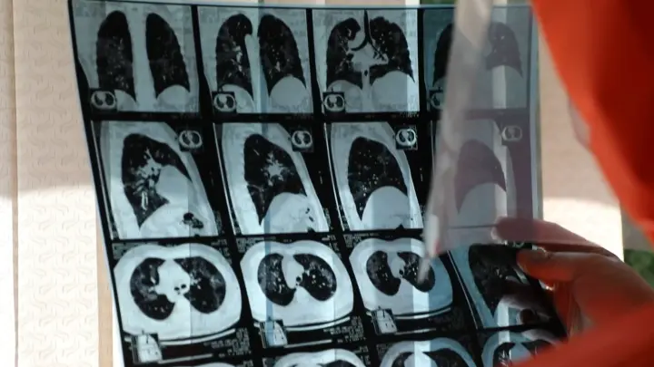 День фтизиатра: поздравления в прозе и стихах