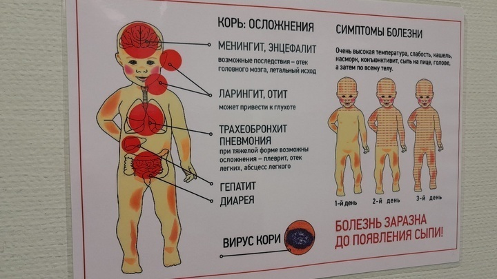19 случаев заражения корью зафиксировано в Нижегородской области