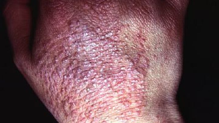 Не щадит ни взрослых ни детей: Мороз принёс черепашью болезнь в Россию