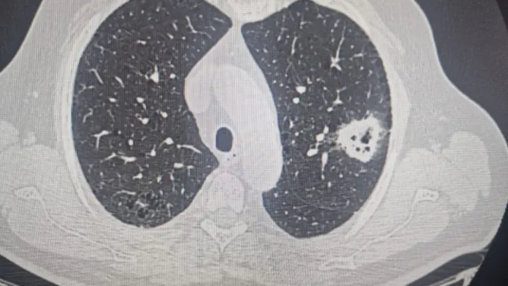Новосибирские онкологи трижды прооперировали пациента с разными опухолями
