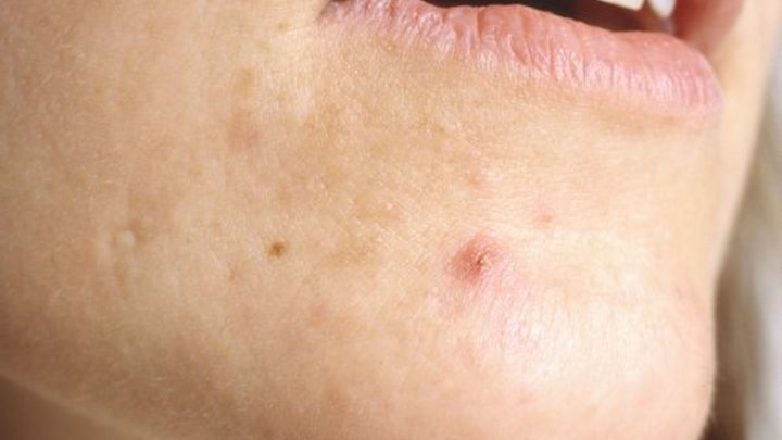 Учёные выяснили, какие продукты помогают в лечении акне