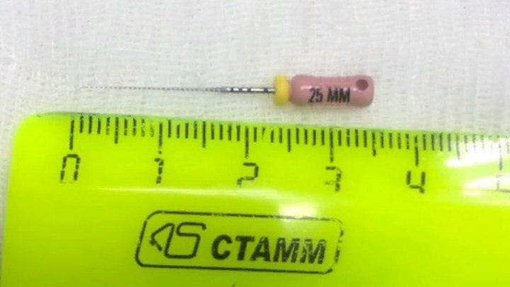 Новороссийские медики извлекли из желудка местной жительницы стоматологический инструмент