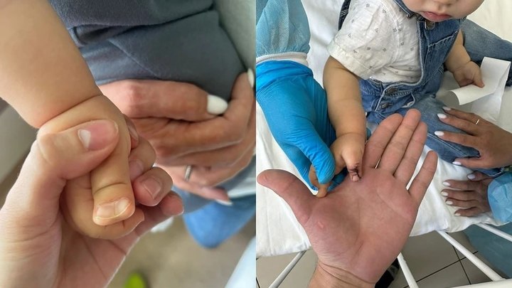 В новосибирском НИИТО прооперировали мальчика с огромным пальцем на руке