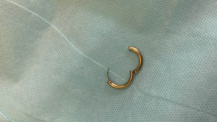 В Туапсе золотую серёжку без операции достали из желудка четырёхлетнего ребёнка