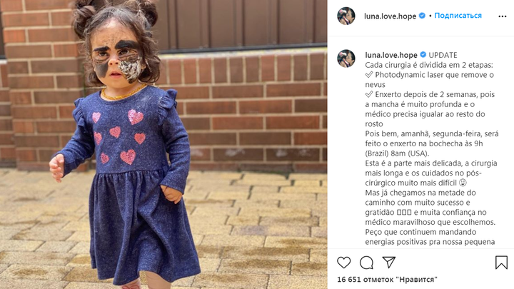 Девочке с «маской Бэтмена» провели очередную операцию в Краснодаре