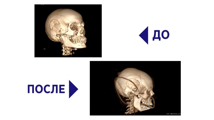 В Подмосковье нейрохирурги вытащили девушку с разбитым черепом с того света
