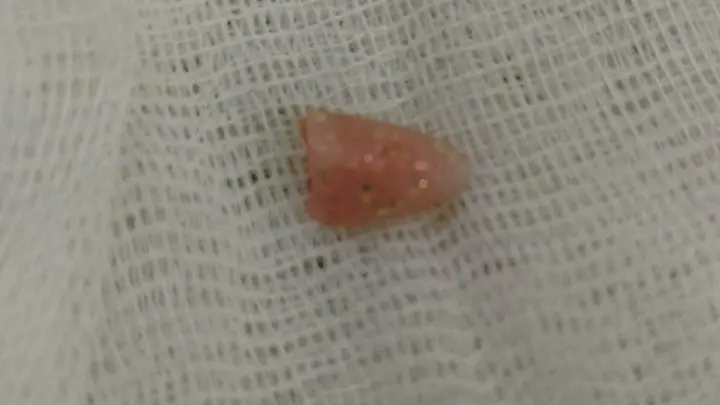 В Челябинске младенец чуть не умер из-за наращенного ногтя