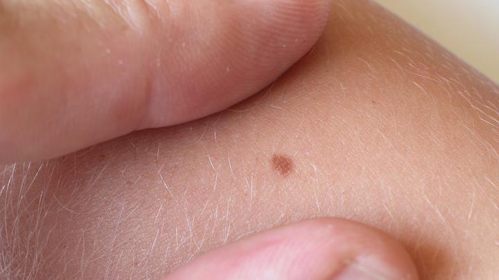 Как распознать опасные родинки: Доктор Мясников предложил простую систему из пяти букв