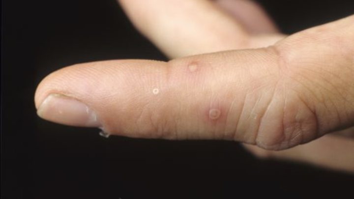 На Кубани выявлены первые случаи заболевания вирусом Коксаки