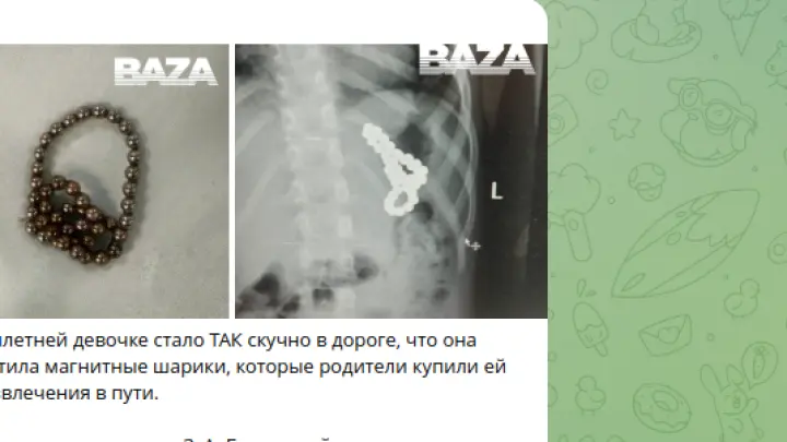 Восьмилетняя девочка от скуки проглотила 46 магнитных шариков и чуть не умерла